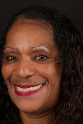 Confident smile transformation after gum contouring with lip repositioning.